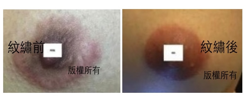 隆乳必看 M小妞隆乳案蓋疤案紋繡例照片
