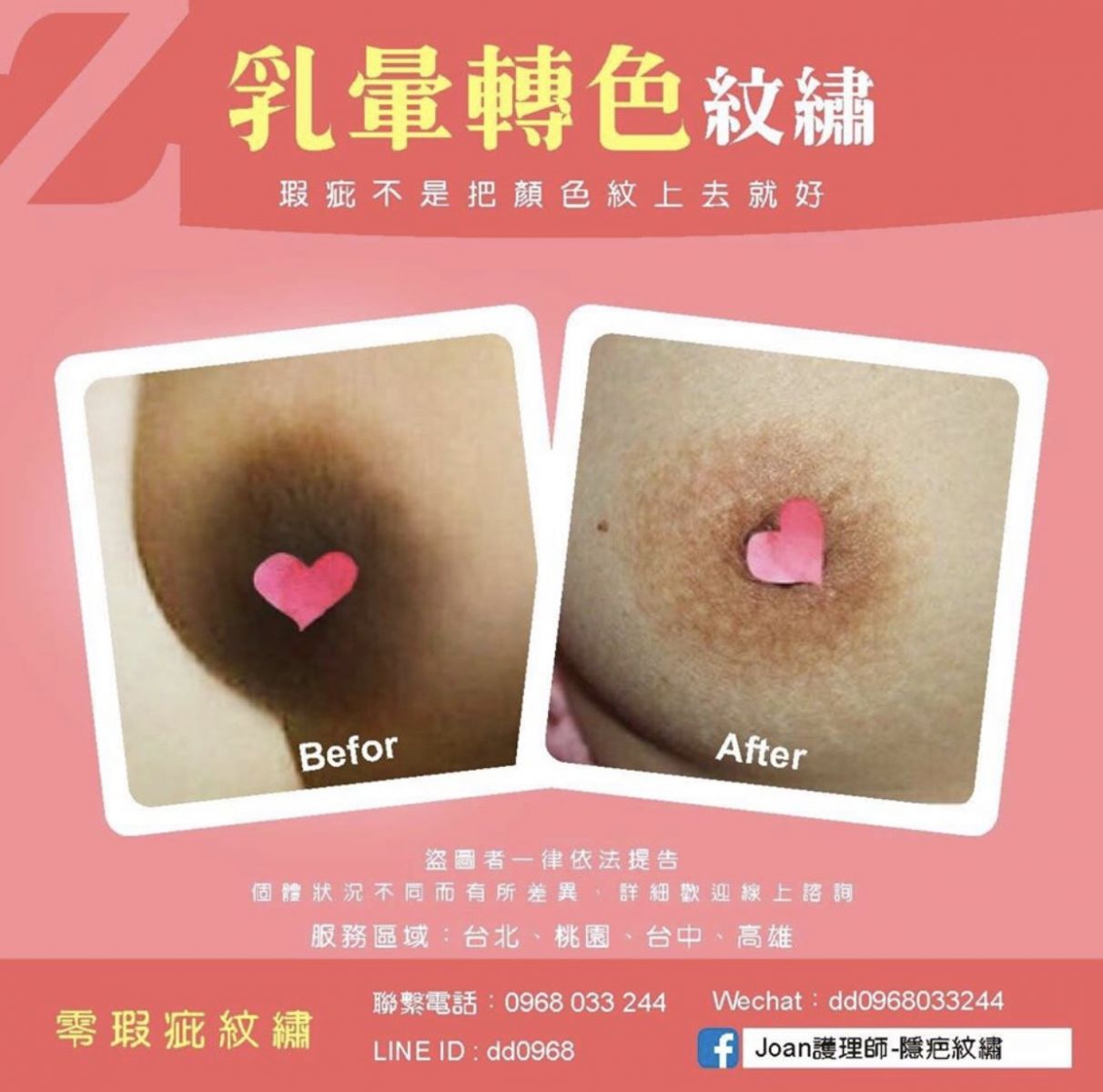 乳暈雷射可以使暗沉的乳暈顏色變淺變淡，更可以鎖小乳暈的範圍