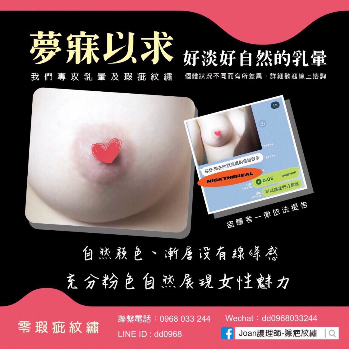 乳暈雷射安全又有效，打擊暗沈的最佳方式！